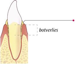 Parodontitis web