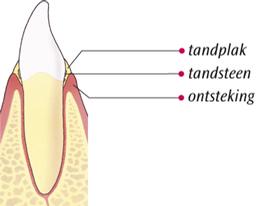Ontstoken tandvlees met tek