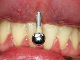 Tongpiercing vies