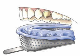 Afdruklepelmetafdrukmateriaal1