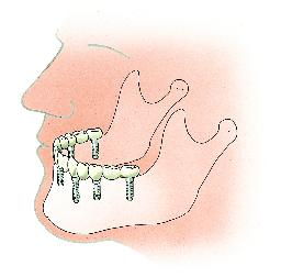 Brug met 6 implantaten