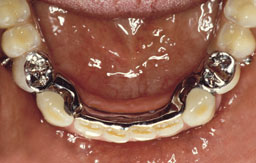 Frameprothese op gipsmodel