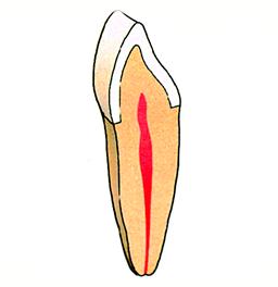 Keramische kroon
