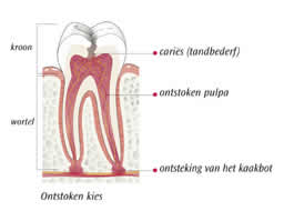 Ontstokenkies