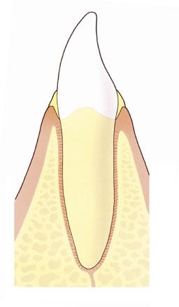 Gingivitus