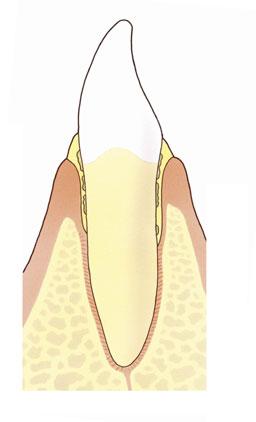 Parodontitis