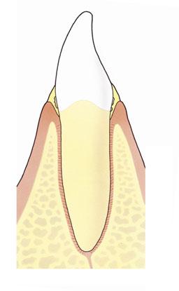 Tandsteen